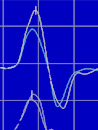 MEP Magnetisch evozierte Potentiale